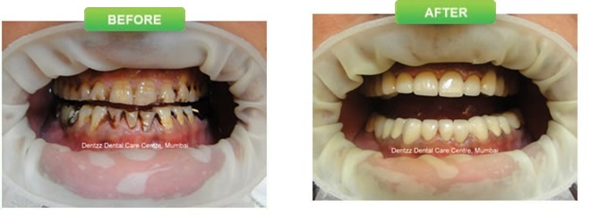 Explore Dental Tourism In India With Dentzz
